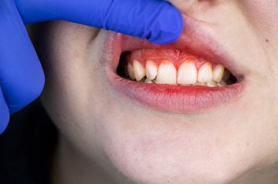 5 Tanda Kekurangan Vitamin yang Dirasakan Melalui Kulit Anda