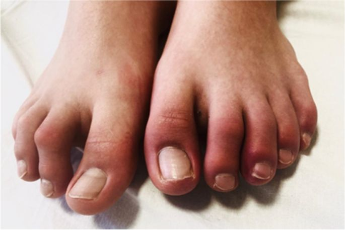 chilblains adalah