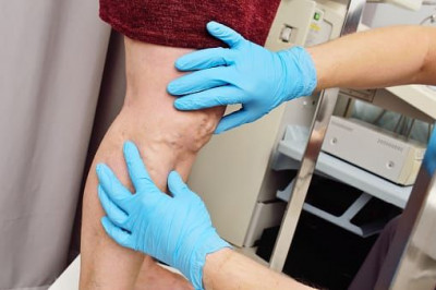 Kekurangan Dua Vitamin ini Berperan dalam Munculnya Varises