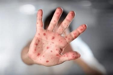 WHO: Monkeypox Bisa Menular Saat Berhubungan Seksual