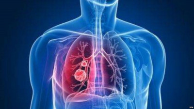 Studi: Perubahan Gaya Hidup Secara Signifikan Turunkan Risiko Kanker
