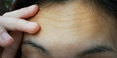 Tips Mencegah dan Mengurangi Kerutan di Dahi