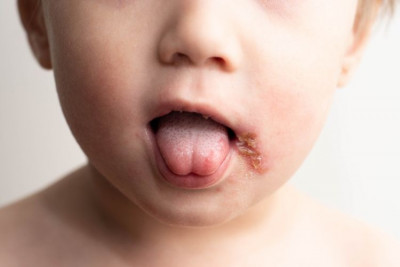 Waspada! Herpes pada Bayi Bisa Sangat Berbahaya
