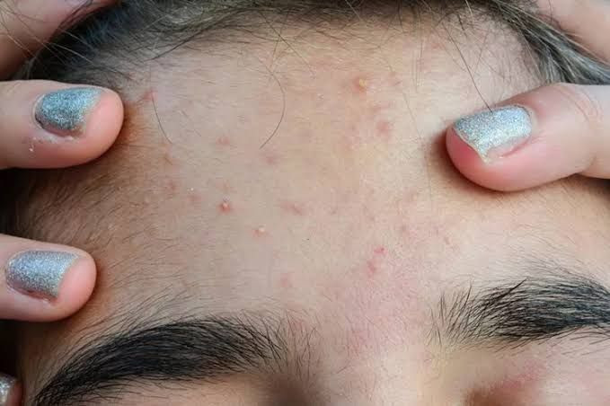 cara menghilangkan bruntusan di hidung