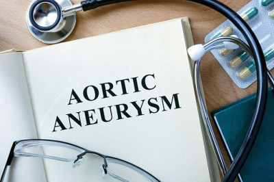 Cara Tepat Tangani Aneurisma Aorta