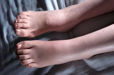 Makanan yang Tepat untuk Menangani Pembengkakan Tubuh