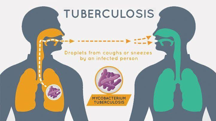Penyebab dan Penanganan Penyakit Tuberkulosis (TBC)