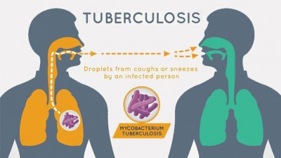 Kenali Penyebab dan Penanganan Penyakit Tuberkulosis (TBC)