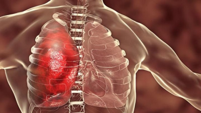 Penyakit Legionellosis, Gejala, Penyebab dan Cara Mengobati