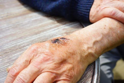 6 Perubahan Kulit yang Bisa Mengindikasi Diabetes