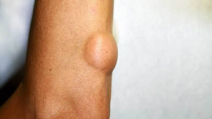 Waspada Benjolan yang Timbul Secara Tiba Tiba