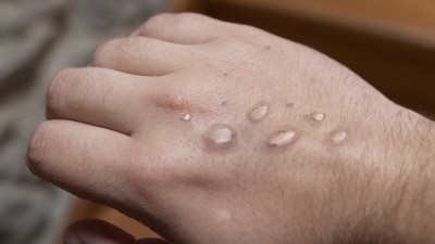 Virus Monkeypox Ditemukan Bermutasi 12 Kali Lebih Cepat