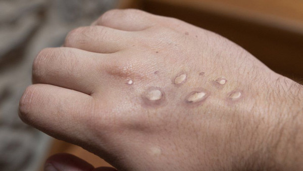 monkeypox