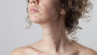 Ini Gejala Awal dari Penyakit Monkeypox