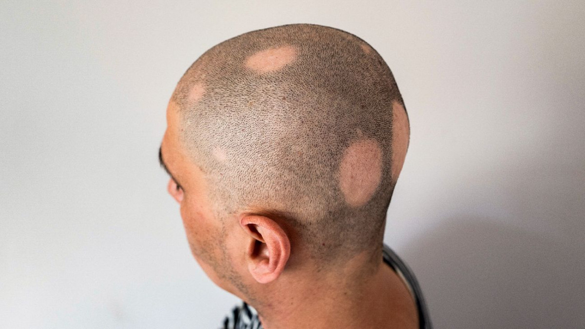 Alopecia