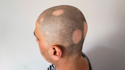 Rambut Rontok hingga Pitak atau Botak, Waspada Alopecia Areata