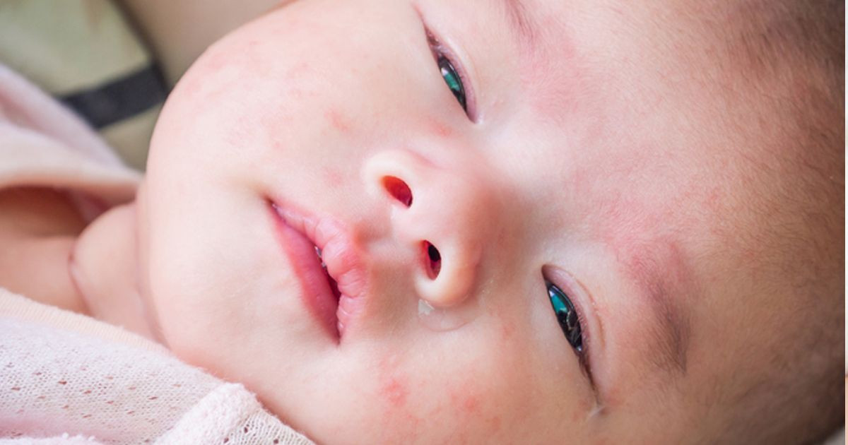Reaksi alergi pada bayi,