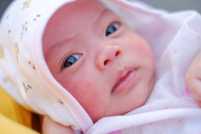 Apakah Jerawat Pada Bayi Itu Berbahaya?