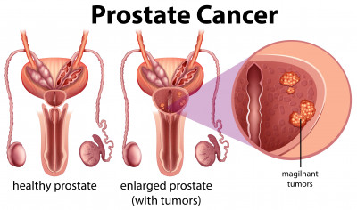 KENALI 6 TANDA MENGIDAP PEMBESARAN PROSTAT YUK!