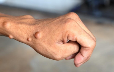 SIMAK GEJALA NEUROFIBROMA BERUPA BENJOLAN KECIL-KECIL DIKULIT YUK
