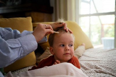 5 CARA ATASI KULIT KEPALA BERKERAK (CRADLE CAP) PADA BAYI