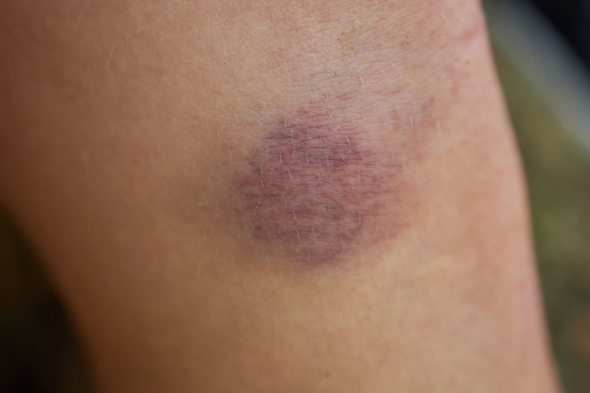 Hematoma, memar