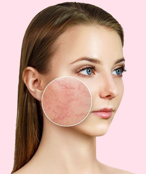 Telangiektasia itu apa, telangiektasia penyebab , telangiektasia gejala, penyebab ciri, varises, kulit putih, urat dipipi, pembuluh darah, rosacea, yesdok