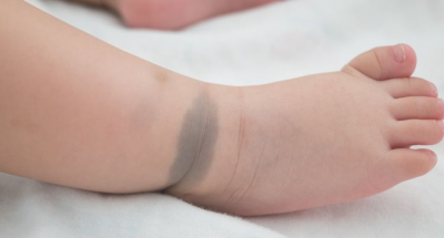 MONGOLIAN SPOT (BERCAK BIRU) PADA BAYI, BERBAHAYAKAH MOMS?
