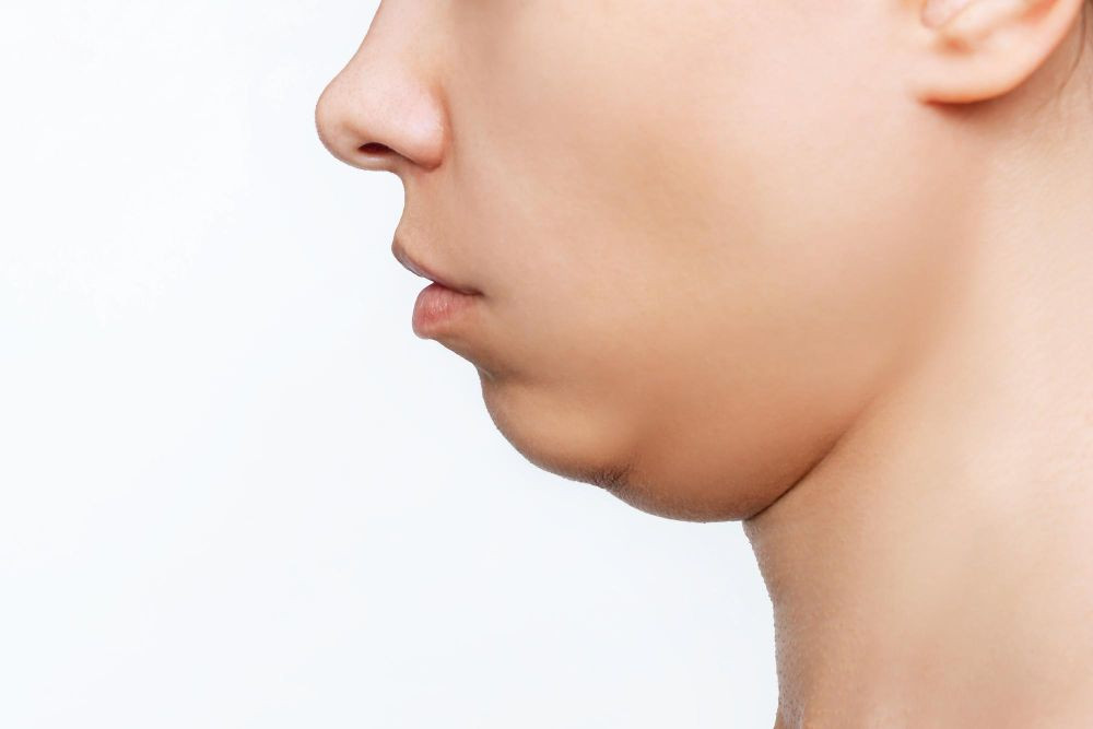 double chin, cara menghilangkan double chin, double chin adalah, menghilangkan double chin, penyebab double chin, apa itu double chin, cara hilangkan double chin, double chin itu apa, yesdok