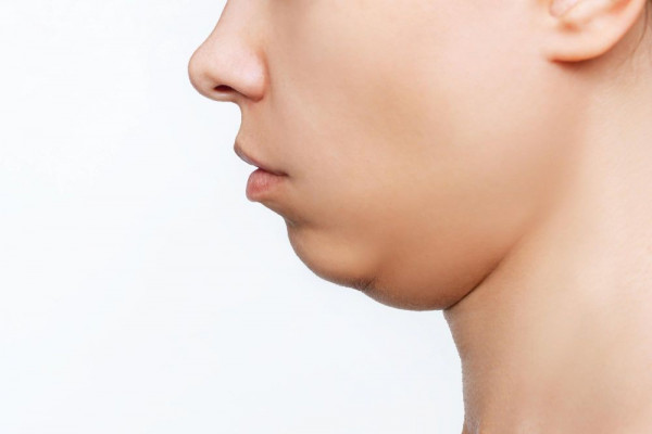 double chin, cara menghilangkan double chin, double chin adalah, menghilangkan double chin, penyebab double chin, apa itu double chin, cara hilangkan double chin, double chin itu apa, yesdok