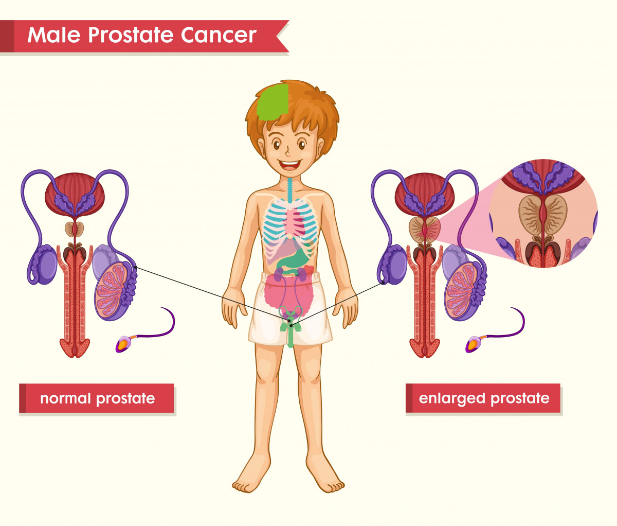 pencegahan prostat, pencegahan prostatitis, cara mencegah kanker prostat, cara mencegah prostat, mencegah prostat, cara mencegah prostatitis, mencegah kanker prostat, pencegahan kanker prostat, yesdok