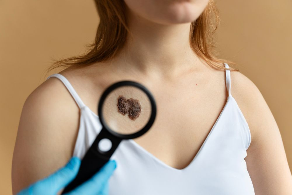 jenis tahi lalat, tahi lalat kanker kulit, tahi lalat yang berpotensi kanker, tahi lalat karena apa, tahi lalat yang berbahaya, tahi lalat yang membesar, yesdok