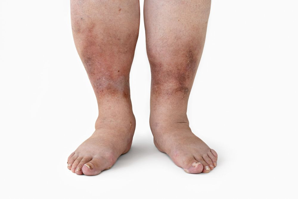 Gangrene, gangrene adalah, luka gangren, luka gangren adalah, apa itu gangrene, gangrene icd 10, luka gangren diabetes, penyebab gangren, gejala gangren, yesdok