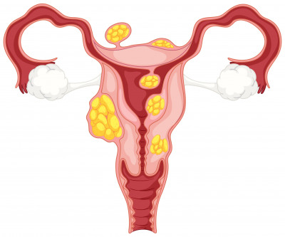 6 GEJALA MENGIDAP FIBROID RAHIM