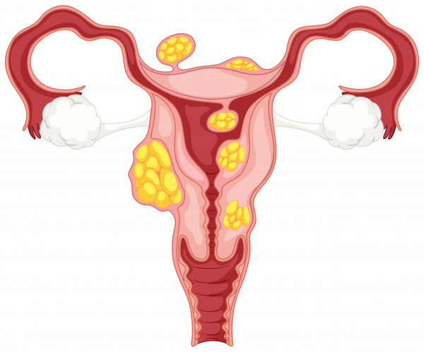 fibroid rahim, fibroid rahim adalah, ciri ciri fibroid rahim, fibroid rahim itu apa, tanda2 fibroid rahim, apakah fibroid rahim berbahaya, penyakit fibroid rahim, yesdok