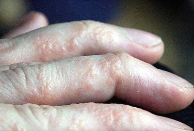 DYSHIDROTIC ECZEMA: BENJOLAN KECIL-KECIL DI JARI, SIMAK PENYEBABNYA YUK!