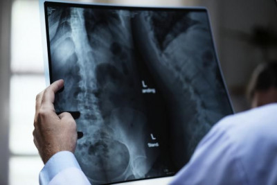 Diet Rendah Kalori Ditambah Berolahraga Bikin Tulang Rapuh
