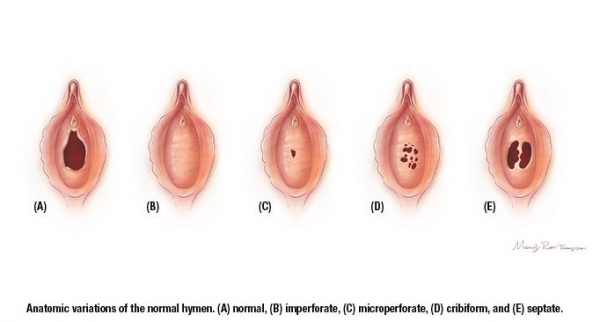 keperawanan, hymen, selaputdara, vagina, annular, cribriform, imperforate, mikroperforasi, septate