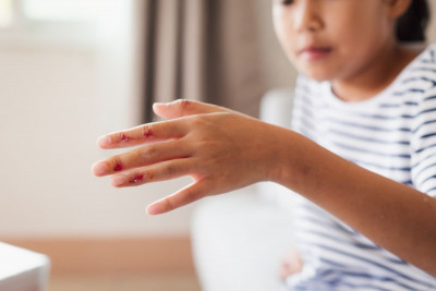 6 GEJALA IMPETIGO BULOSA PADA KULIT ANAK