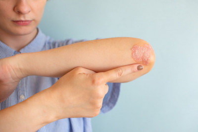Bercak Merah yang Gatal, Ini 5 Gejala Dermatitis Numularis