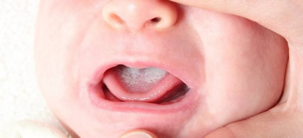 Lidah Putih Pada Bayi, Bahayakah?