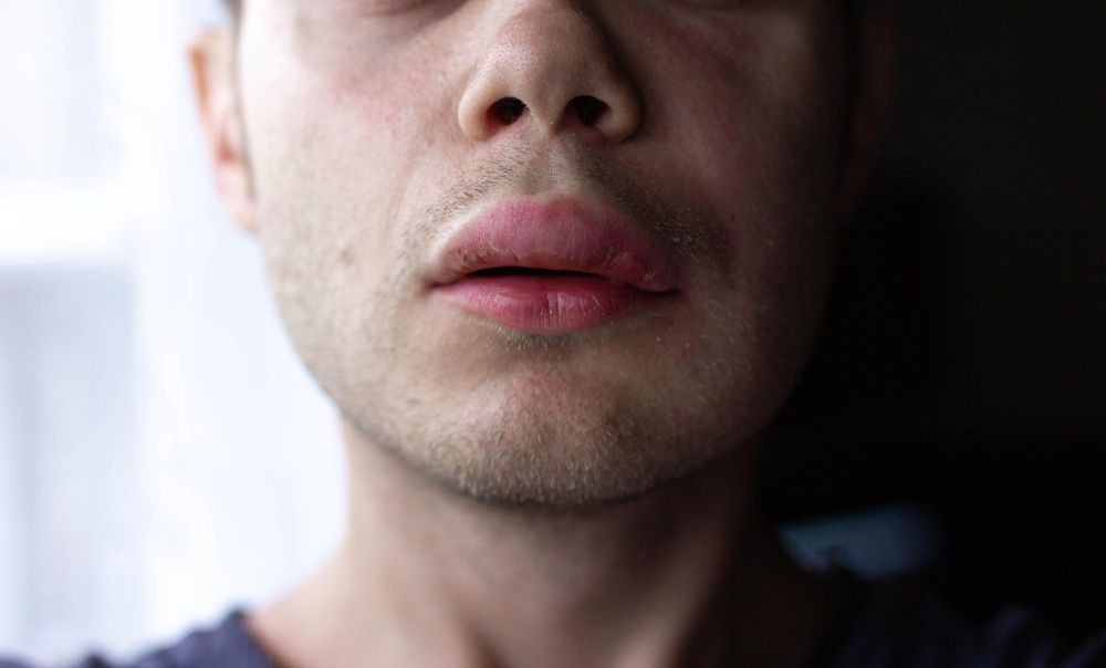 Angioedema, angioedema adalah, apa itu angioedema, penyebab angioedema, kode icd 10 angioedema, angioedema bibir, angioedema herediter, angioedema treatment, yesdok