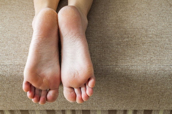 4 Cara Atasi Kapalan di Kulit