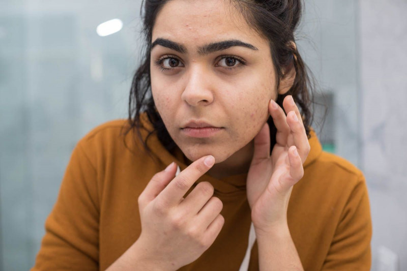 Muncul Jerawat di Dagu? Atasi dengan Cara Ini | YesDok