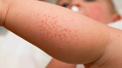 Cegah Alergi Sejak Dini Pada Bayi