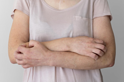 ALERGI PADA SINAR MATAHARI, KENALI GEJALA XERODERMA PIGMENTOSUM (XP)