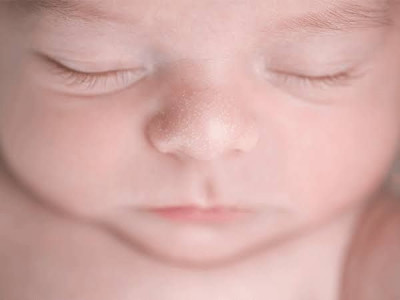 Penyebab Munculnya Milia Pada Bayi