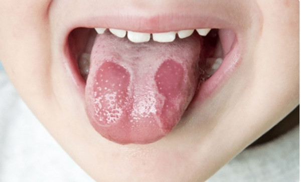Geographic Tongue, Bercak Putih Mengerikan Pada Lidah Anak