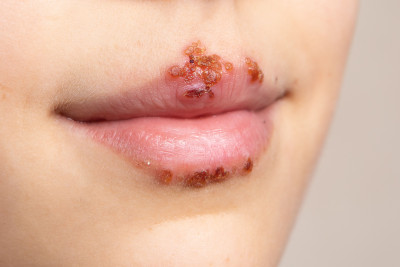 BIBIR SERING TERKELUPAS, WASPADAI GEJALA HERPES DI BIBIR!