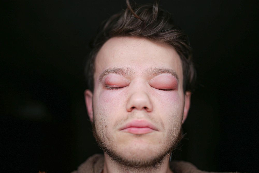 Angioedema, angioedema adalah, apa itu angioedema, penyebab angioedema, kode icd 10 angioedema, angioedema bibir, angioedema herediter, angioedema treatment, yesdok